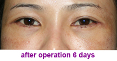 plastic-surgery-blepharoplasty